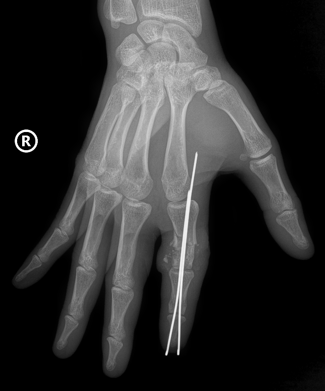 Lần đầu tiên tại Việt Nam, một bệnh viện làm nên kỳ tích “hồi sinh” ngoạn mục này