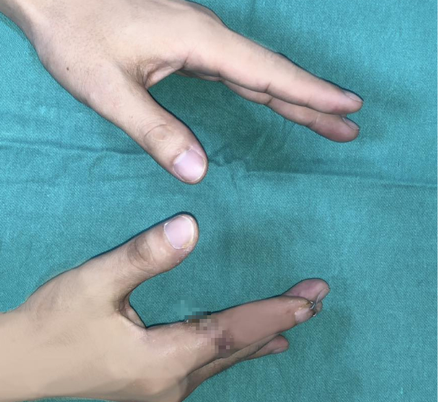 Ca phẫu thuật diễn ra thành công với ngón tay được nối liền sau 25 giờ