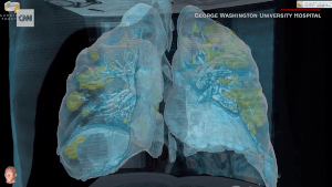 Virus SARS-CoV-2 tàn phá lá phổi của con người như thế nào?