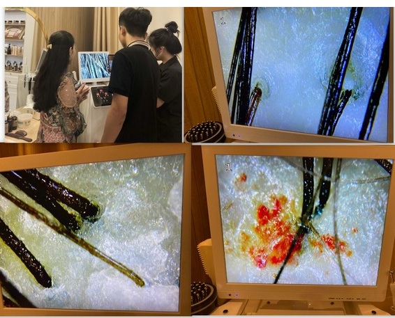 Da đầu bị bít tắt silicone có trong dầu gội đầu công nghiệp.