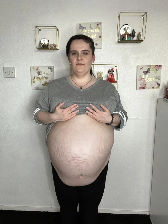 Tưởng mang thai, người phụ nữ không ngờ mình bị u nang buồng trứng nặng 16kg