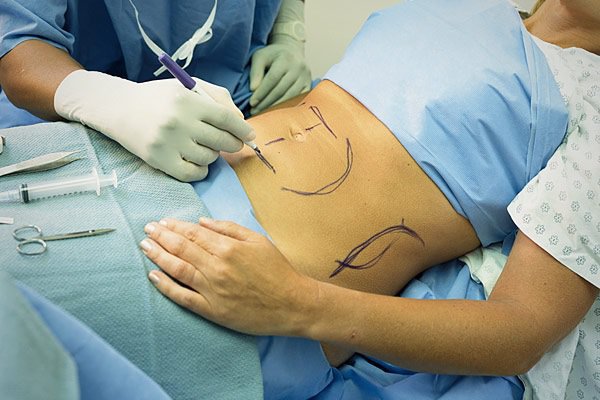 Từng trải qua phẫu thuật cắt dạ dày có thể làm tăng nguy cơ bị tiểu đường thai kỳ. (Ảnh minh họa)