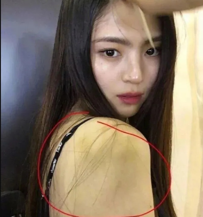 Cánh tay của Han So Hee cũng xuất hiện vết bầm