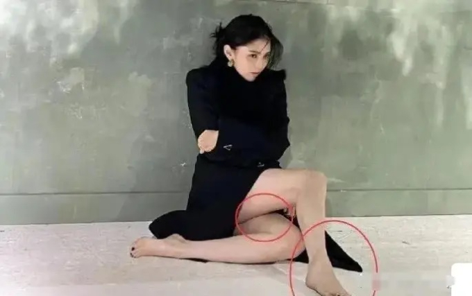 Vết bầm tím xuất hiện trên bắp đùi và cổ chân của Han So Hee