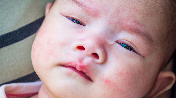 Trẻ em có làn da rất nhạy cảm và có thể phản ứng mạnh với các chất hóa học độc hại, gây ra các triệu chứng như ngứa, đỏ da, phát ban. (Ảnh minh họa)