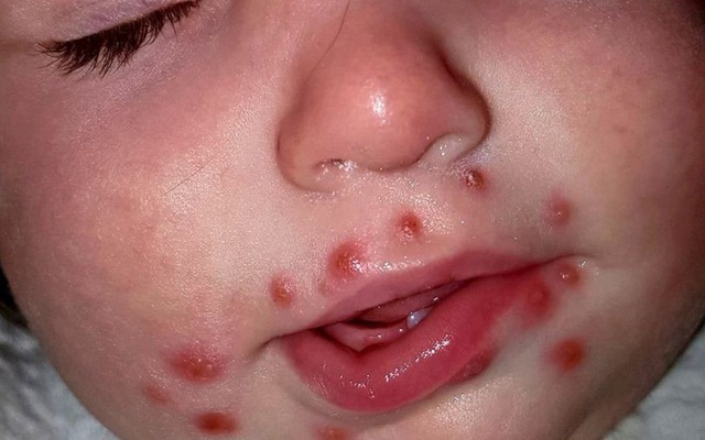 Trẻ bị nhiễm virus Herpes gây ra những mụn nước quanh miệng. Ảnh: afamily.vn