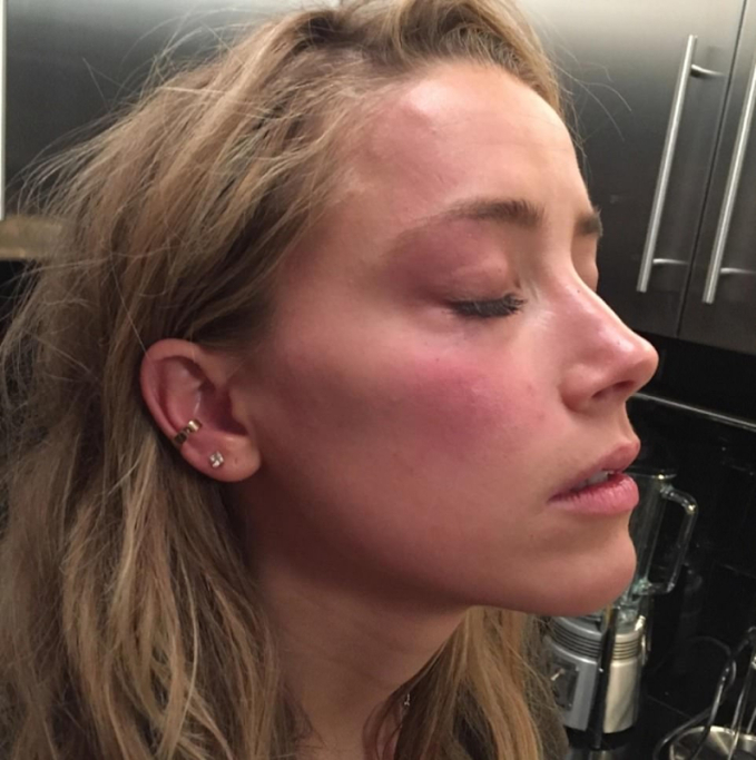 Amber Heard công khai khuôn mặt sau khi bị Johnny Depp ném điện thoại vào mặt. Ảnh: Daily Mail (UK)