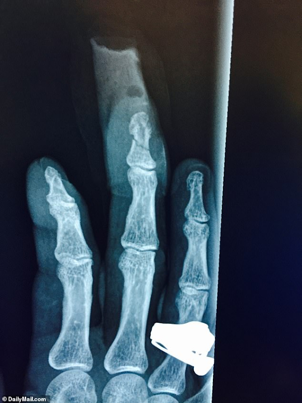 Ảnh chụp X-quang của bác sĩ cho thấy đầu ngón tay bị đứt lìa của Depp. Ảnh: Daily Mail (UK)