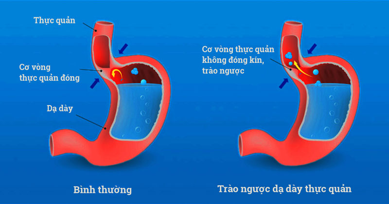 Nếu phát hiện sớm, GERD thường không gây nguy hiểm và có thể kiểm soát hiệu quả.