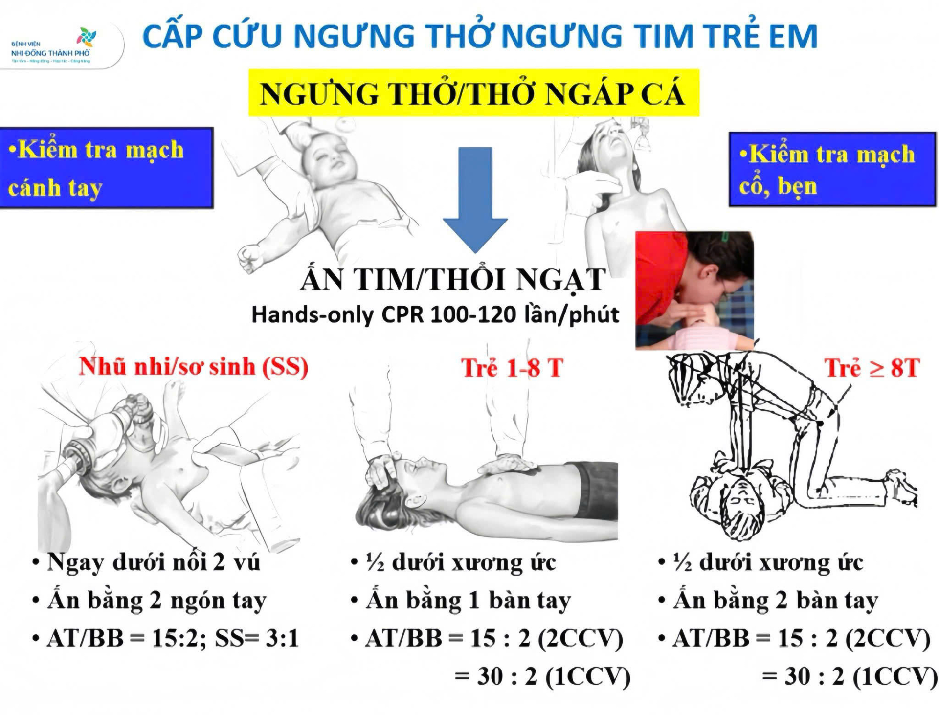 Các bước sơ cấp cứu cho trẻ bị đuối nước (ảnh: BV Nhi đồng Thành phố).