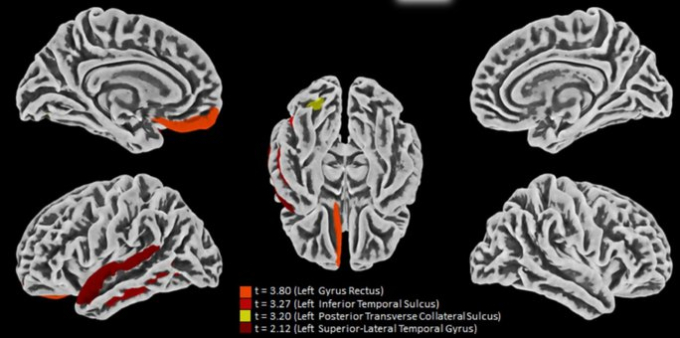 Các vùng não có dấu hiệu bị thay đổi ở các bệnh nhân chết vì COVID-19 được thể hiện bằng màu sắc - Ảnh: PNAS