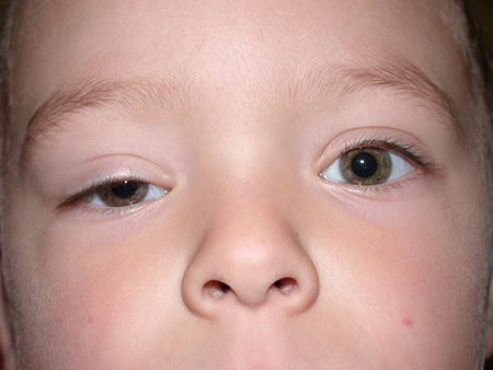 Trẻ hay chớp mắt là thói quen hay bệnh tật?