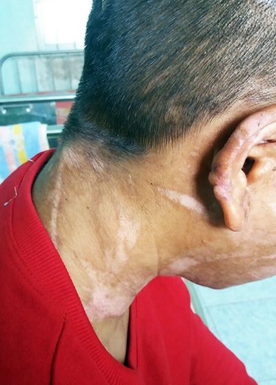 Những vết sẹo chi chít trên cơ thể Y Nhiêu nghi do bị tra tấn bằng hung khí. Ảnh: Vnexpress