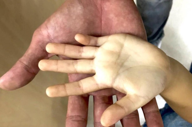 Hình ảnh bàn tay trắng toát của bé gái do lạm dụng sữa tươi mỗi ngày. Ảnh: BSCC.