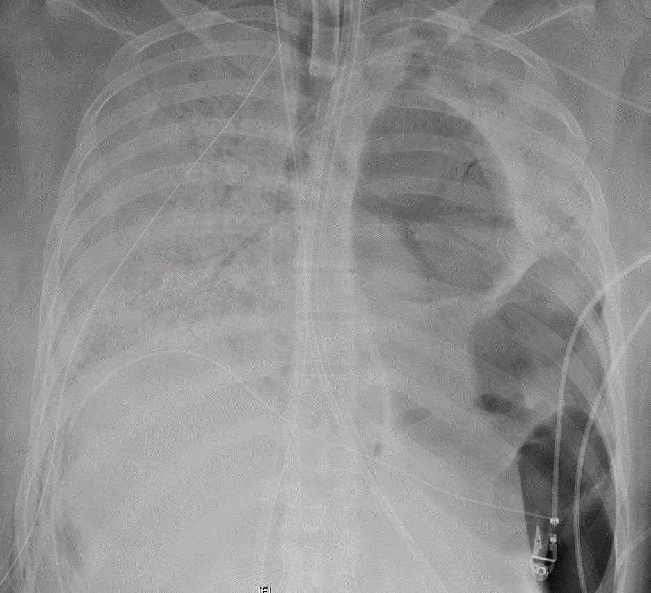 Chụp X-quang phổi của bệnh nhân trước khi cấy ghép, cho thấy tổn thương nghiêm trọng. Ảnh: Northwestern Medicine.