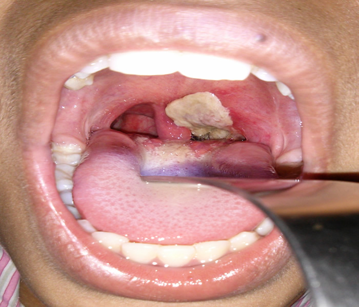 Triệu chứng dễ nhận thấy nhất của bệnh bạch hầu là hình thành mảng màu xám, dày ở họng và amidan. Ảnh minh họa