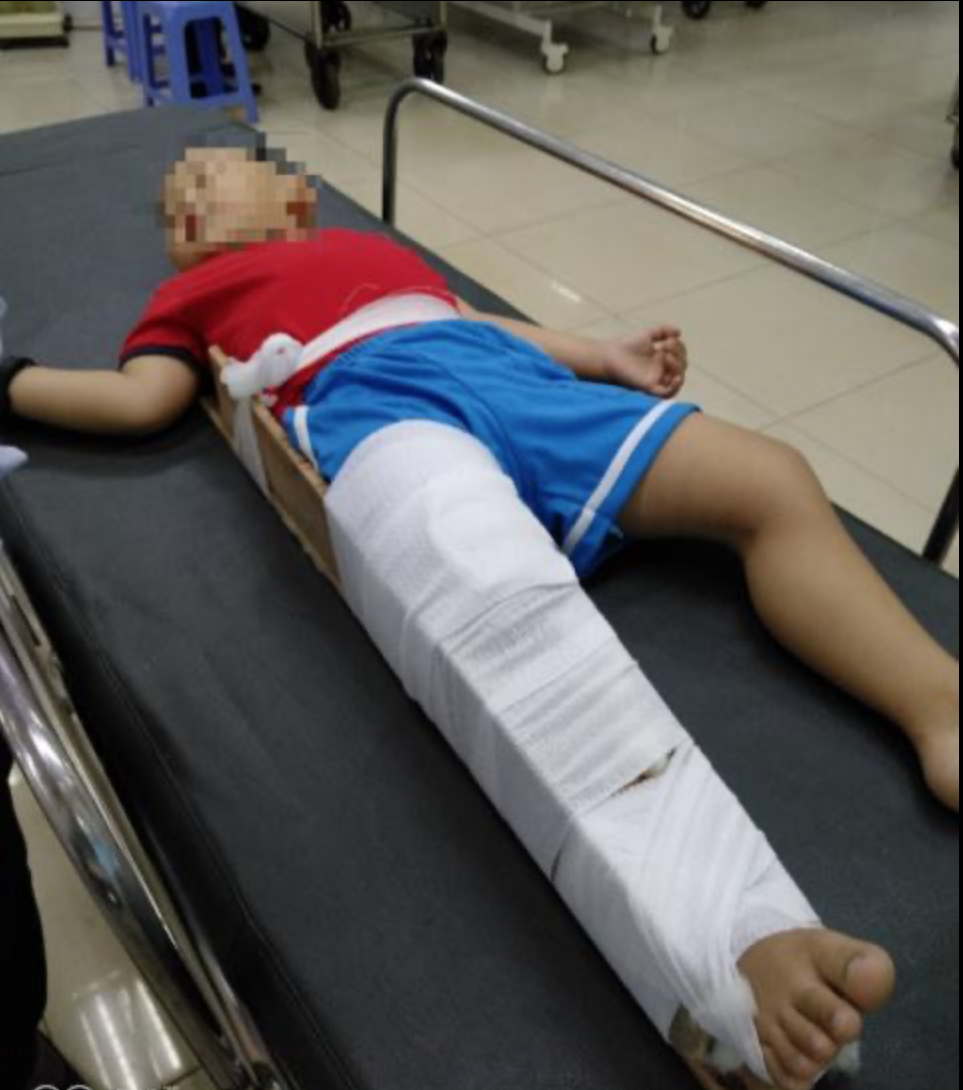 Bé P. đang điều trị tại bệnh viện Nhi Đồng 1 (TP.HCM). Ảnh: Dân Trí