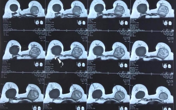 Hình chụp X-quang cho thấy chị H. bị vỡ túi ngực nhân tạo bên trái.