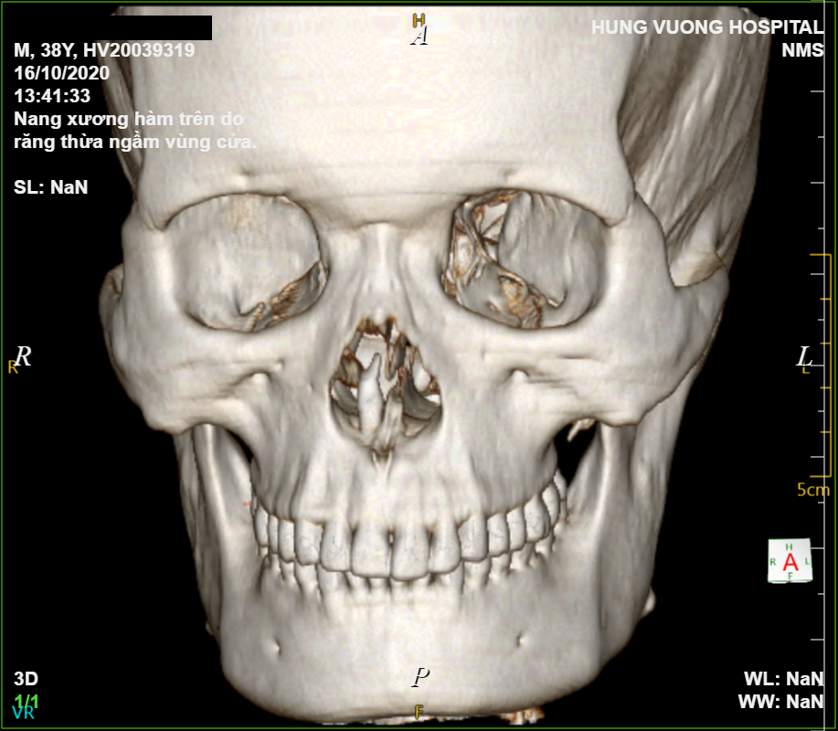  Hình ảnh chụp Xquang, bệnh nhân bị răng ngầm chọc thủng hốc mũi.