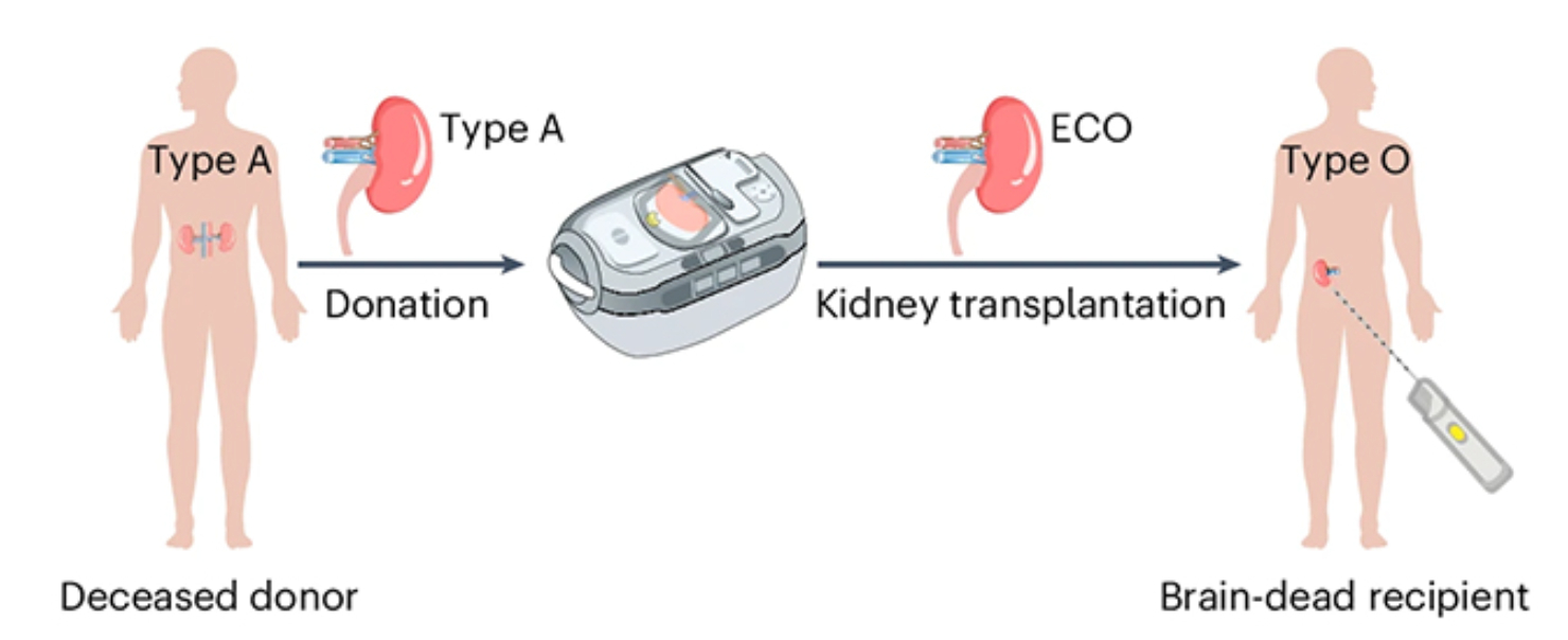 Các nhà khoa học đã biến đổi thành công thận nhóm A sang trạng thái tương đương nhóm O bằng enzyme, sẵn sàng cho việc cấy ghép. Ảnh: Nature Biomedical Engineering