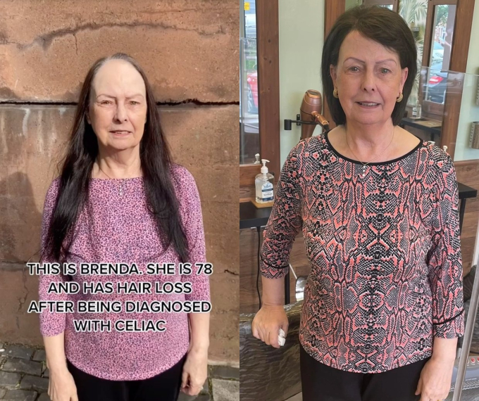 Bà Brenda thay đổi ngoại hình sau khi bỏ ra hơn 10 triệu để cấy tóc.
