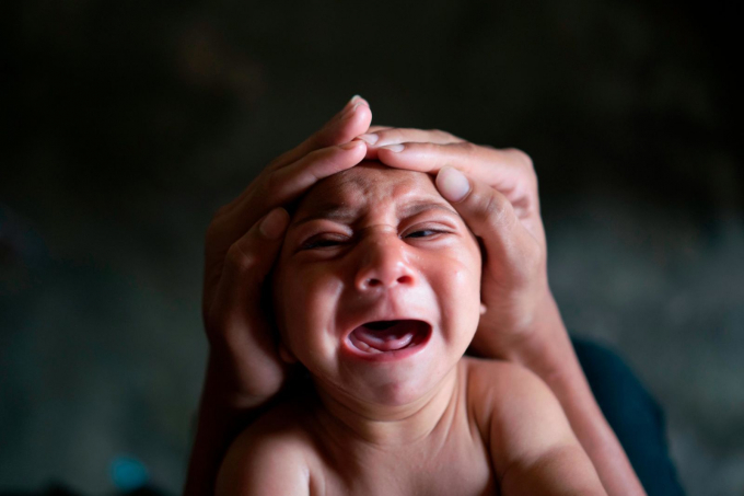 Jose Wesley, một em bé bị mắc bệnh Microcephaly, khóc ở Bonito, Brazil, vào tháng 1 năm 2016. Microcephaly là một rối loạn thần kinh dẫn đến trẻ sơ sinh có đầu nhỏ và phát triển não bất thường. Một đợt bùng phát của virus Zika có liên quan đến sự gia tăng của các em bé bị dị tật bẩm sinh. Ảnh: Felipe Dana / AP