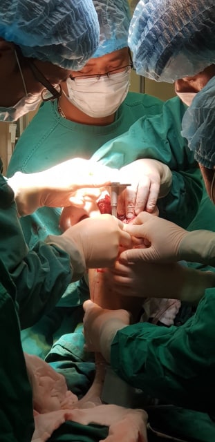 Việt Nam lần đầu tiên cắt bỏ thành công khối u xương chày, phục hồi hoàn toàn chân cho bệnh nhân