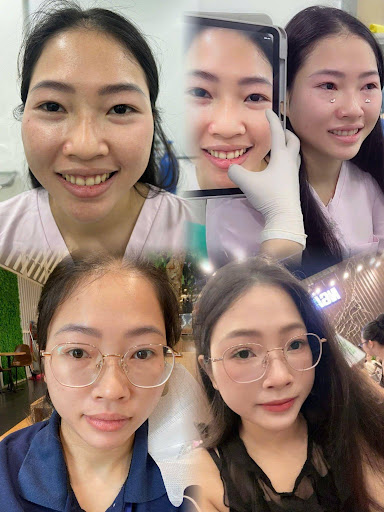 Hình ảnh bệnh nhân sau khi được BS Hùng xử lý dàn mỡ mí dưới không cắt da.