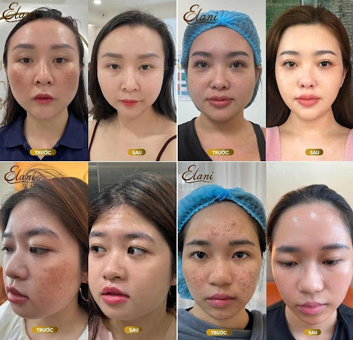 Xu hướng điều trị da kết hợp công nghệ cao tại Phòng khám Da liễu Elani