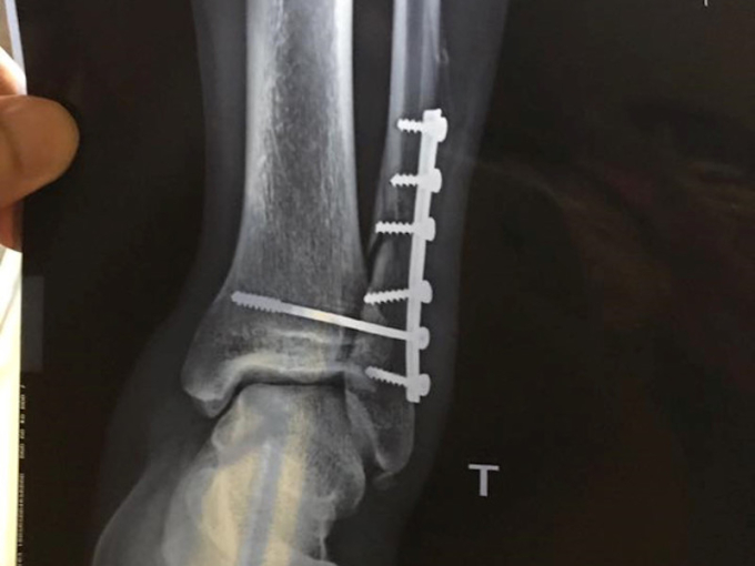Cổ chân trái của Dương Văn Hào được cố định bằng 6 chiếc đinh sau ca phẫu thuật đầu tiên.