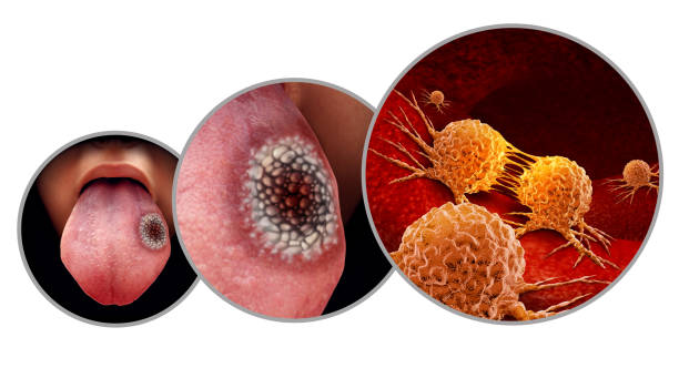 Mô phỏng ung thư miệng (Ảnh: Shutterstock)
