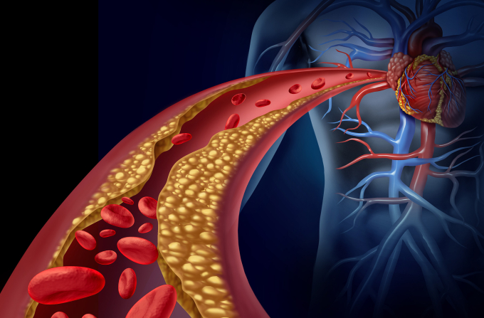 Bệnh mạch vành có thể dẫn tới ngừng tim (Ảnh minh họa)