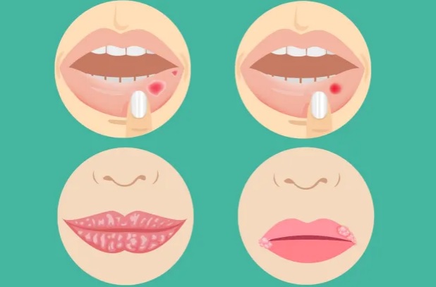 Có nhiều dấu hiệu trên môi có thể cảnh báo bệnh nghiêm trọng.