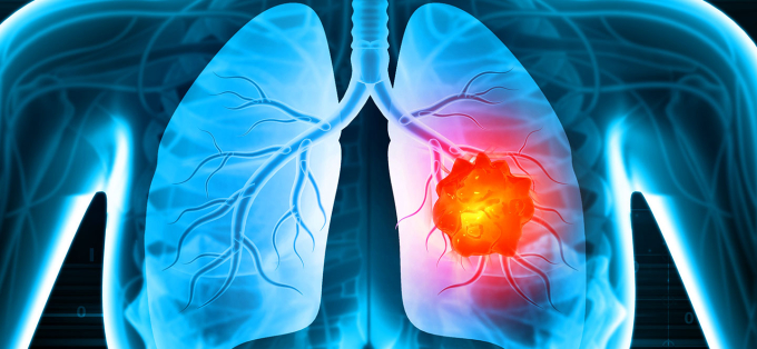 Hình ảnh mô phỏng ung thư phổi (Ảnh: ST)