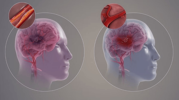 Hình ảnh mô phỏng 2 dạng đột quỵ: đột quỵ do xuất huyết và đột quỵ do thiếu máu cục bộ (Ảnh: The Print)