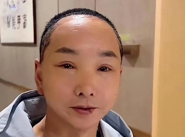 Gương mặt sau phẫu thuật thẩm mỹ giúp người đàn ông trẻ ra 30 tuổi nhưng lại khiến nhiều người khiếp sợ. Ảnh: Sohu