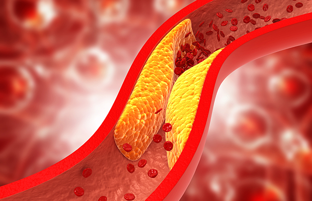 Quá nhiều cholesterol ‘xấu’ có thể làm tắc nghẽn động mạch. (Ảnh minh họa)