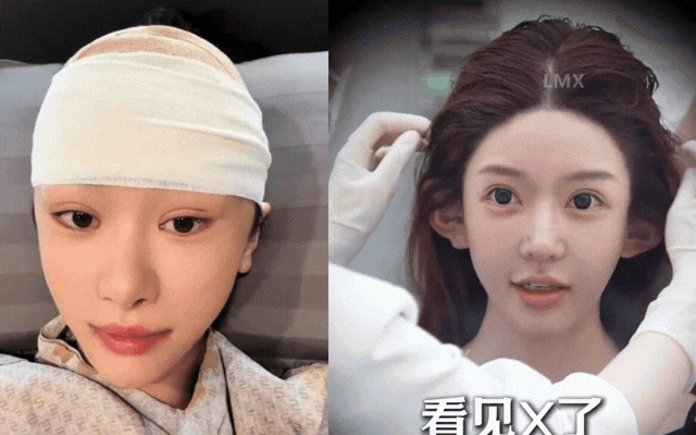  Tất tần tật về xu hướng 'cao hộp sọ' ở Trung Quốc: Hậu quả sau màn bơm 'xi măng xương', tiêm chất làm đầy lên da đầu