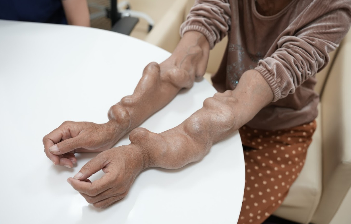 Chạy thận 15 năm, cánh tay “phình như bóng”: Bác sĩ phát hiện nguyên nhân ít ai ngờ