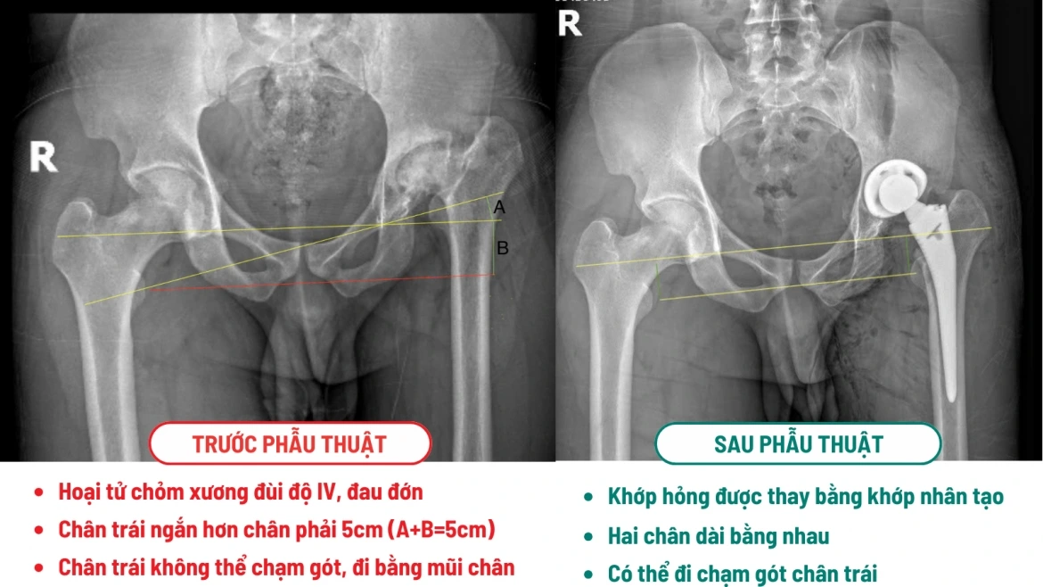 Chịu đau đớn suốt 10 năm, kỹ sư nước ngoài vượt 10.000km sang Việt Nam phẫu thuật: “Cảm giác như được tái sinh”