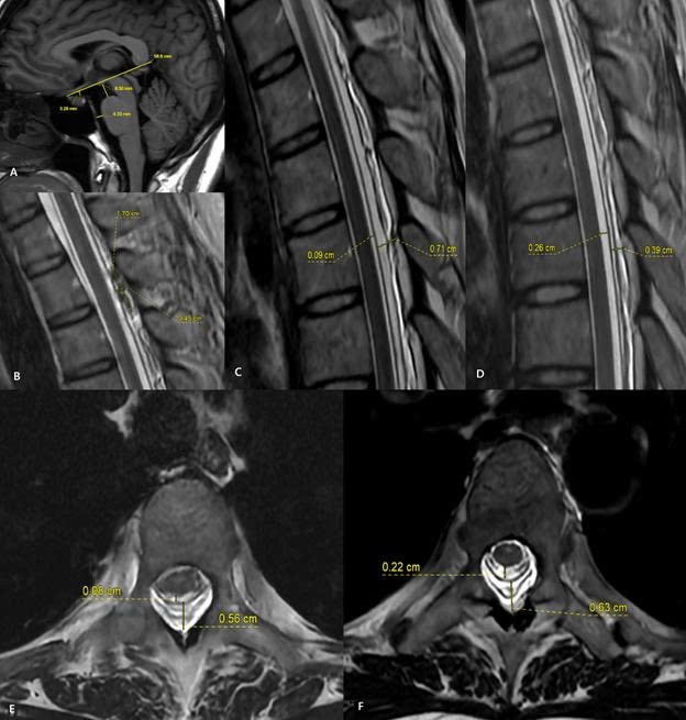 Hình ảnh MRI trước và sau thủ thuật vá máu ngoài màng cứng (EBP). Sau điều trị, khoang chứa dịch não tủy quanh tủy sống được mở rộng trở lại, trong khi khoang ngoài màng cứng thu hẹp rõ rệt. Những thay đổi này cho thấy áp lực dịch não tủy đã được cải thiện sau thủ thuật.