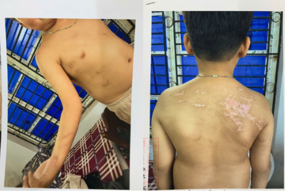 Những vết thương do chính bố ruột gây ra (Ảnh: TTTĐTCATPT)