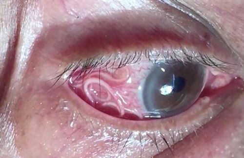 Giun đũa chó, mèo trú ngụ ở mắt bệnh nhân