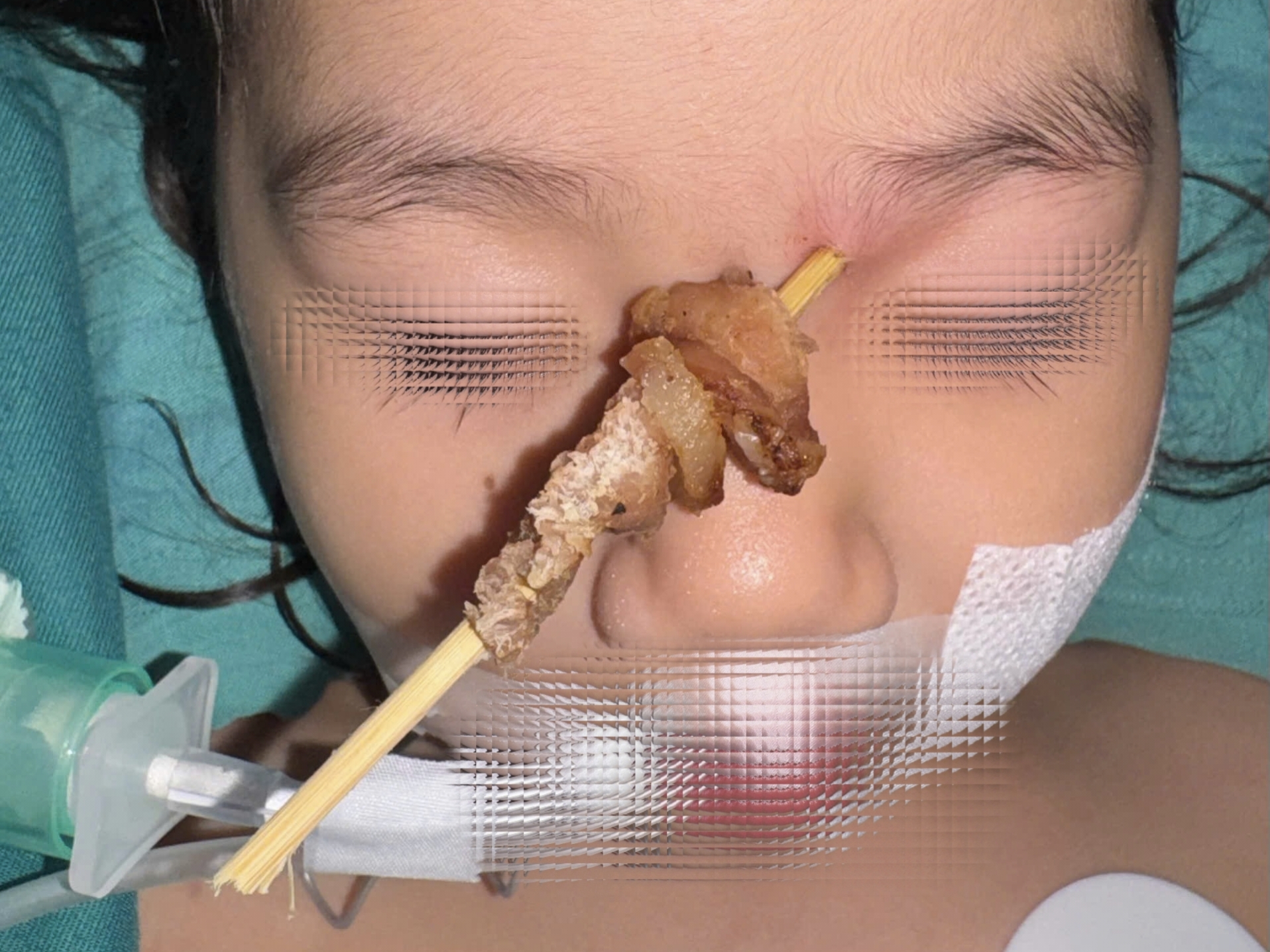 Bé gái bị que xiên thịt đâm xâu nguy hiểm