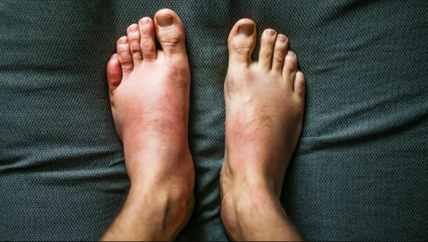 Phù nề chân là biểu hiện điển hình của bệnh thận mạn