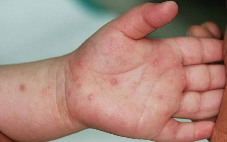 Trẻ đã mắc tay chân miệng, hoàn toàn có thể mắc bệnh lại