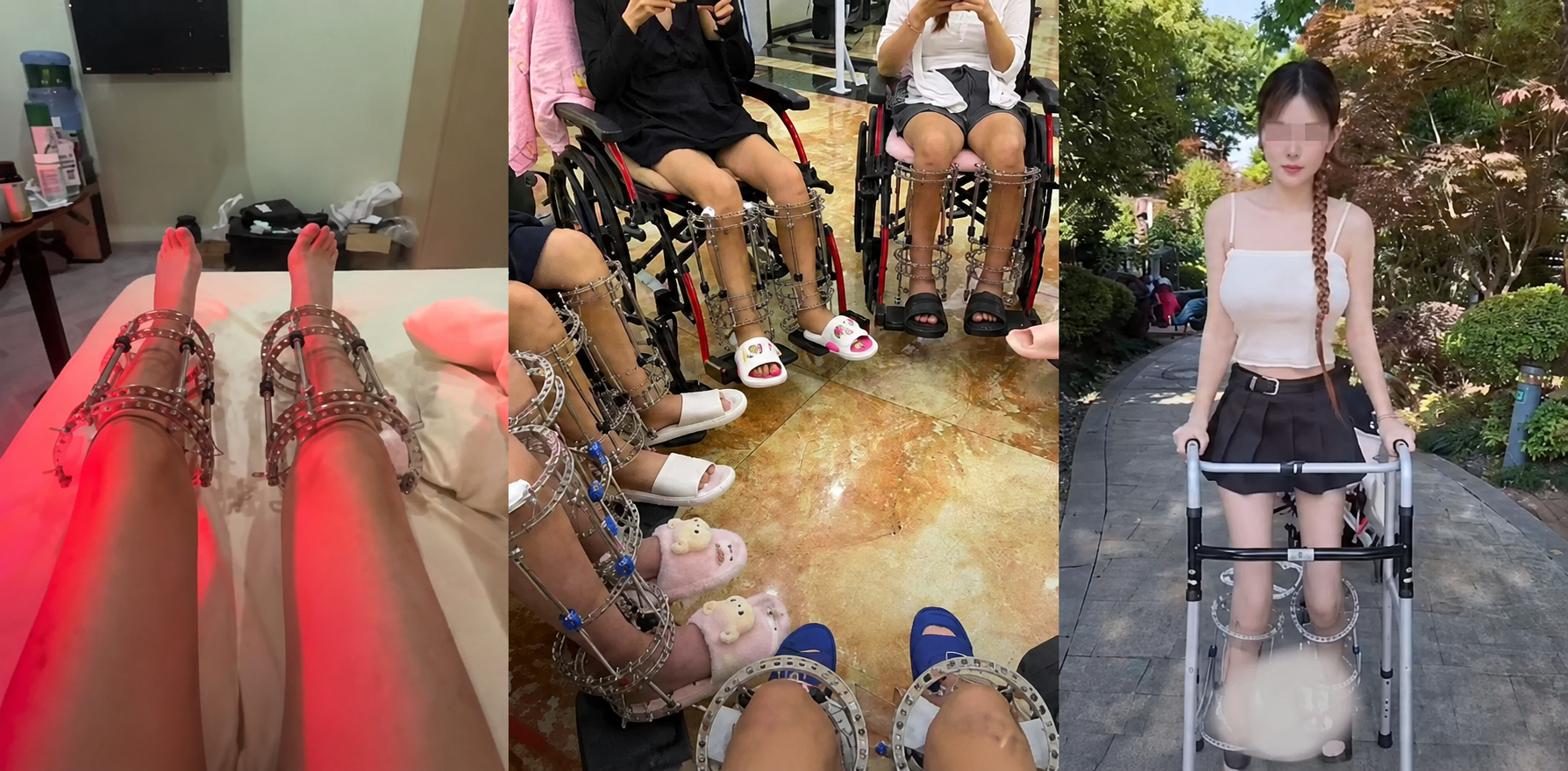 Các bệnh nhân phẫu thuật kéo dài chi tại một cơ sở phẫu thuật ngầm