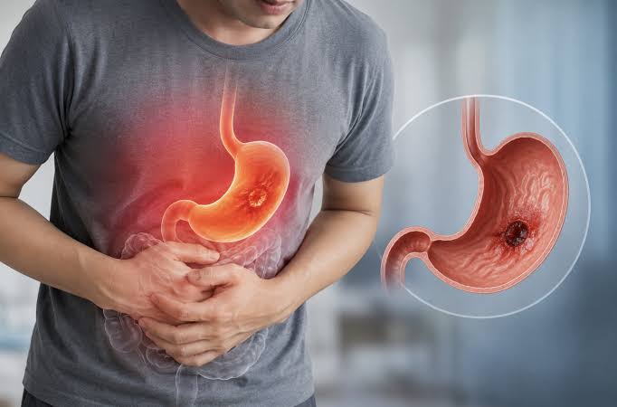 Bác sĩ cảnh báo: 4 DẤU HIỆU khi ăn là biểu hiện của ung thư dạ dày, nhiều người Việt chỉ nghĩ là trạng thái cơ thể bình thường
