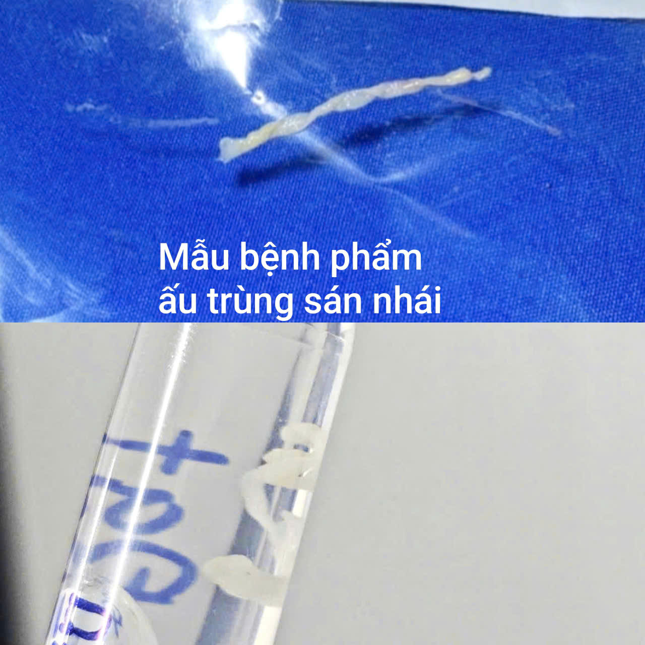 Ấu trùng sán nhái được bác sĩ lấy từ đùi của bệnh nhân - Ảnh: BVCC