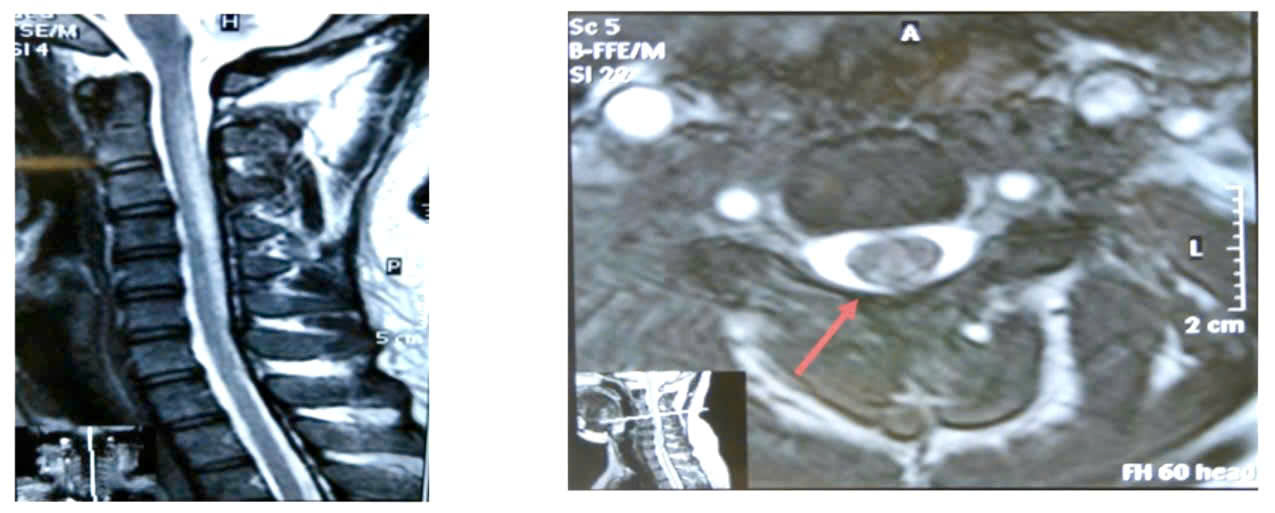 Hình ảnh tổn thương trên MRI cột sống cổ - Ảnh: BVCC